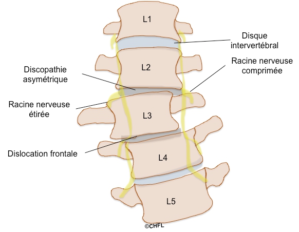 Scoliose Lombaire D g n rative scoliose-lombaire-d-g-n-rative
