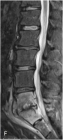 Spondylodiscite L5-S1 post-discectomie
